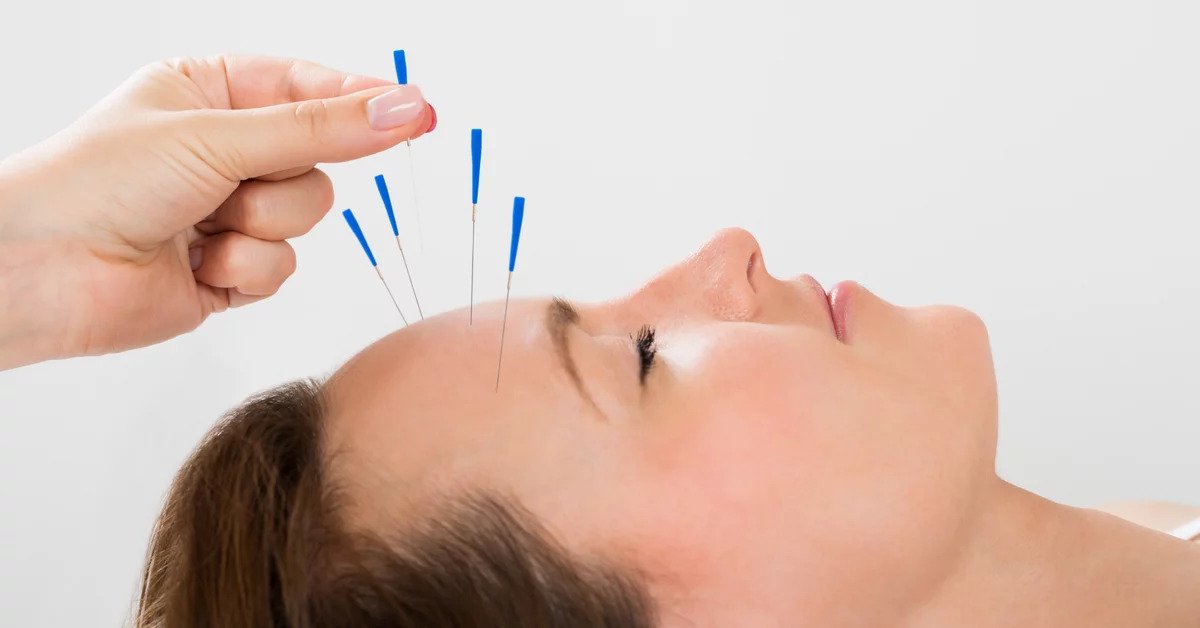 picture of acupuncturist in action, inserting acupuncture needles into loose areolar tissue
                     layer of a patients scalp to stimulate the brain neurons of the underlying area.